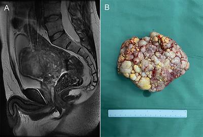 A case report of adenofibroma arising from the seminal vesicle: A rare giant pelvic mass